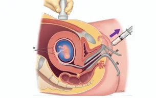 CVS Procedure Suite